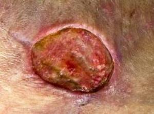 Wound infection - what�s all the fuss about?